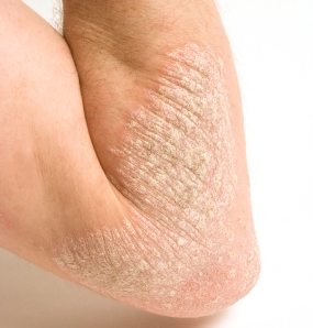 Psoriasis - pikkelysömör - kezelés Harkányban